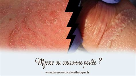 papule perlée|Papule : Symptômes et traitements